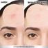 Antes y después pimple patch Garnier